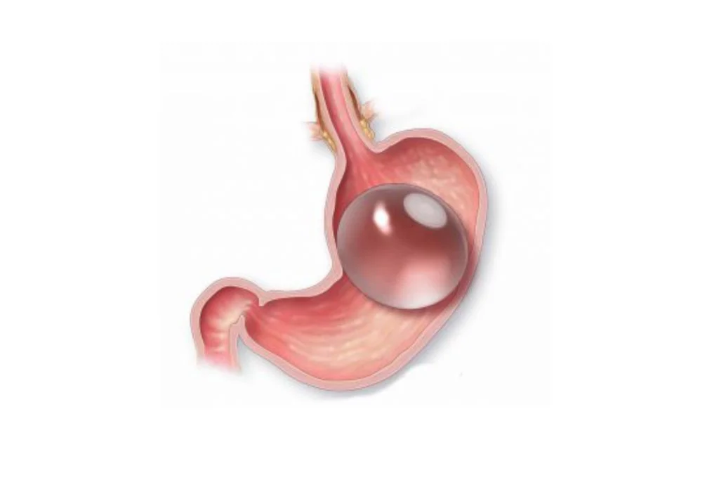 Gastric Balloon Placement