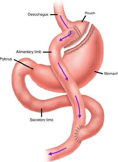 Gastric Bypass Anatomy