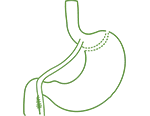 Gastric Bypass Surgery