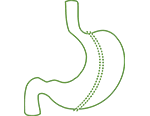 Gastric Sleeve Surgery