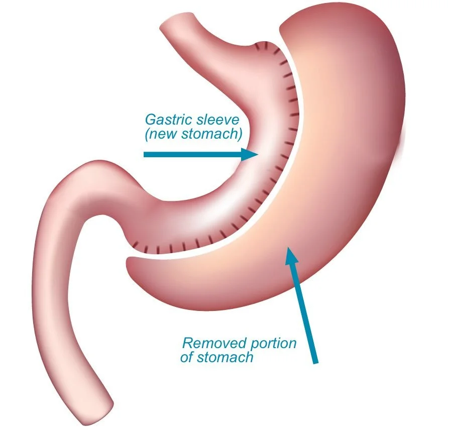 Gastric Sleeve Anatomy