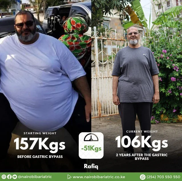 Rafiq Ahmed Gastric Bypass | Inspiring Weight Loss