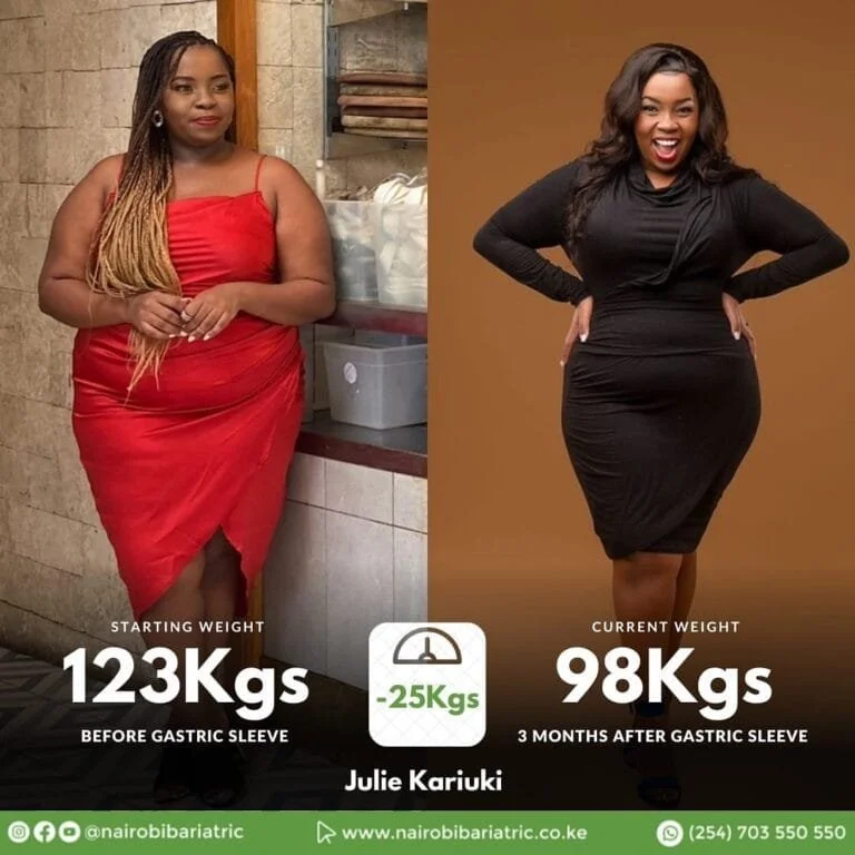 Julie Kariuki Gastric Sleeve | Success Story