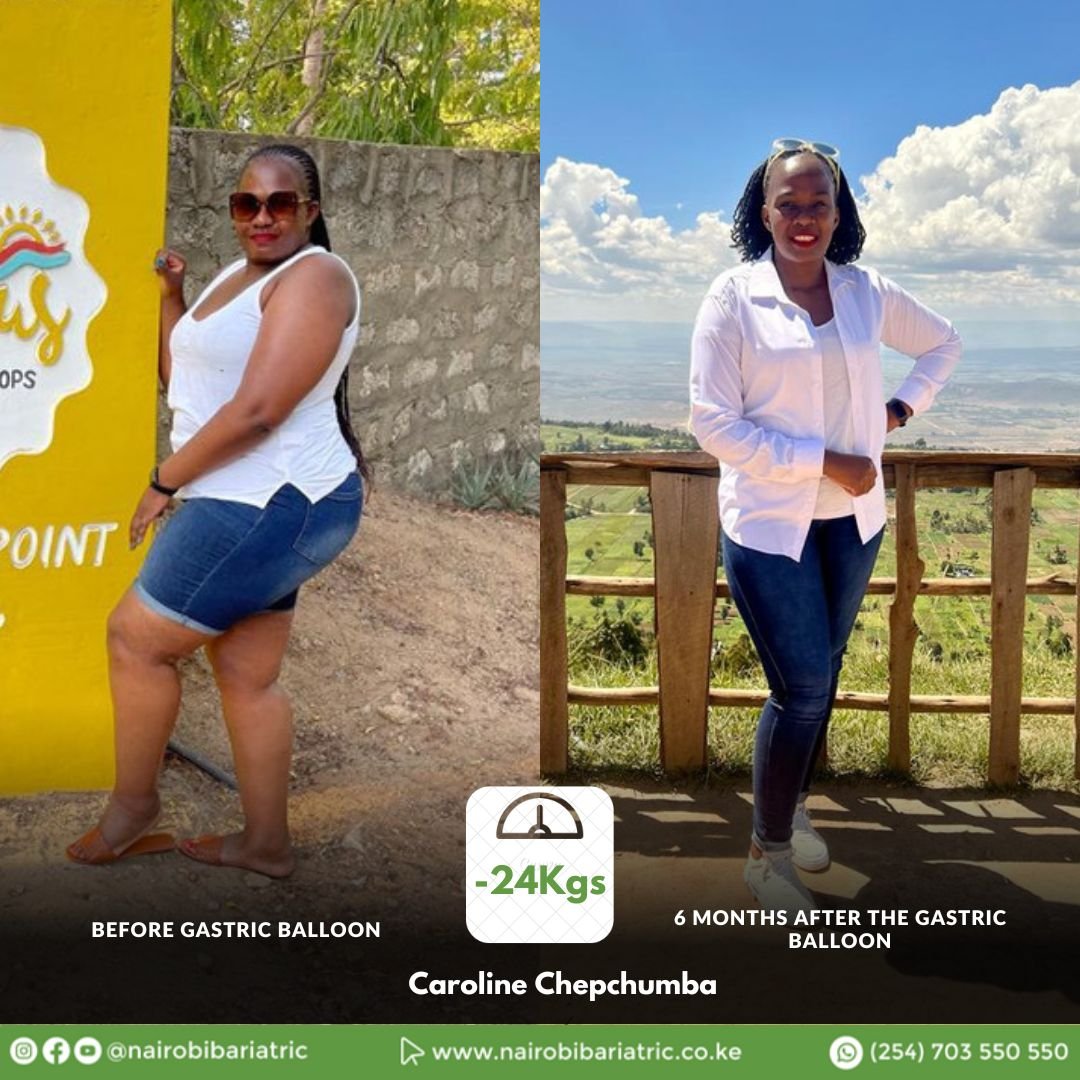 Caroline Chepchumba — Gastric Balloon