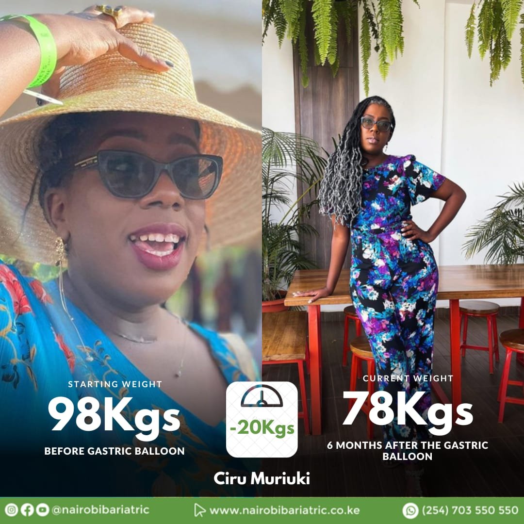 Ciru Muriuki — Gastric Balloon