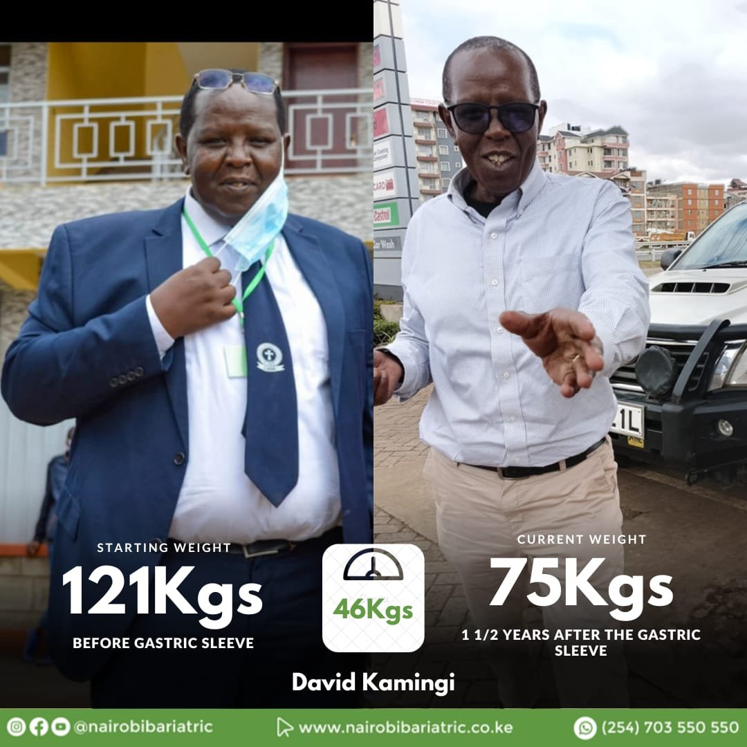 Eng. David Kamingi — Gastric Bypass