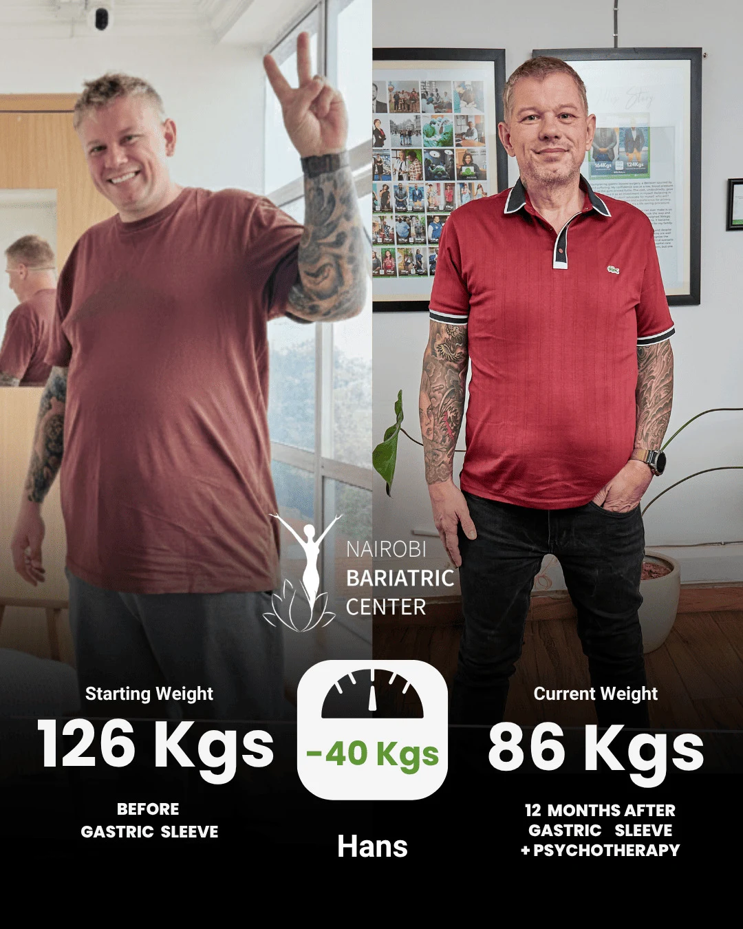 Hans — Gastric Sleeve