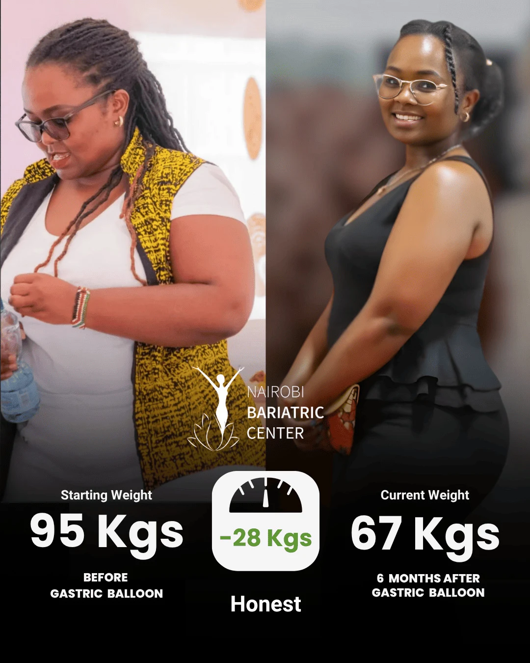 Honest — Gastric Balloon