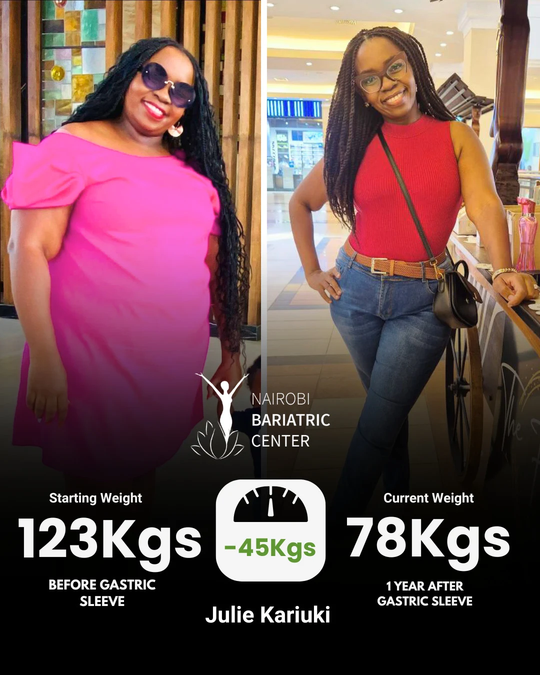 Julie Kariuki — Gastric Sleeve