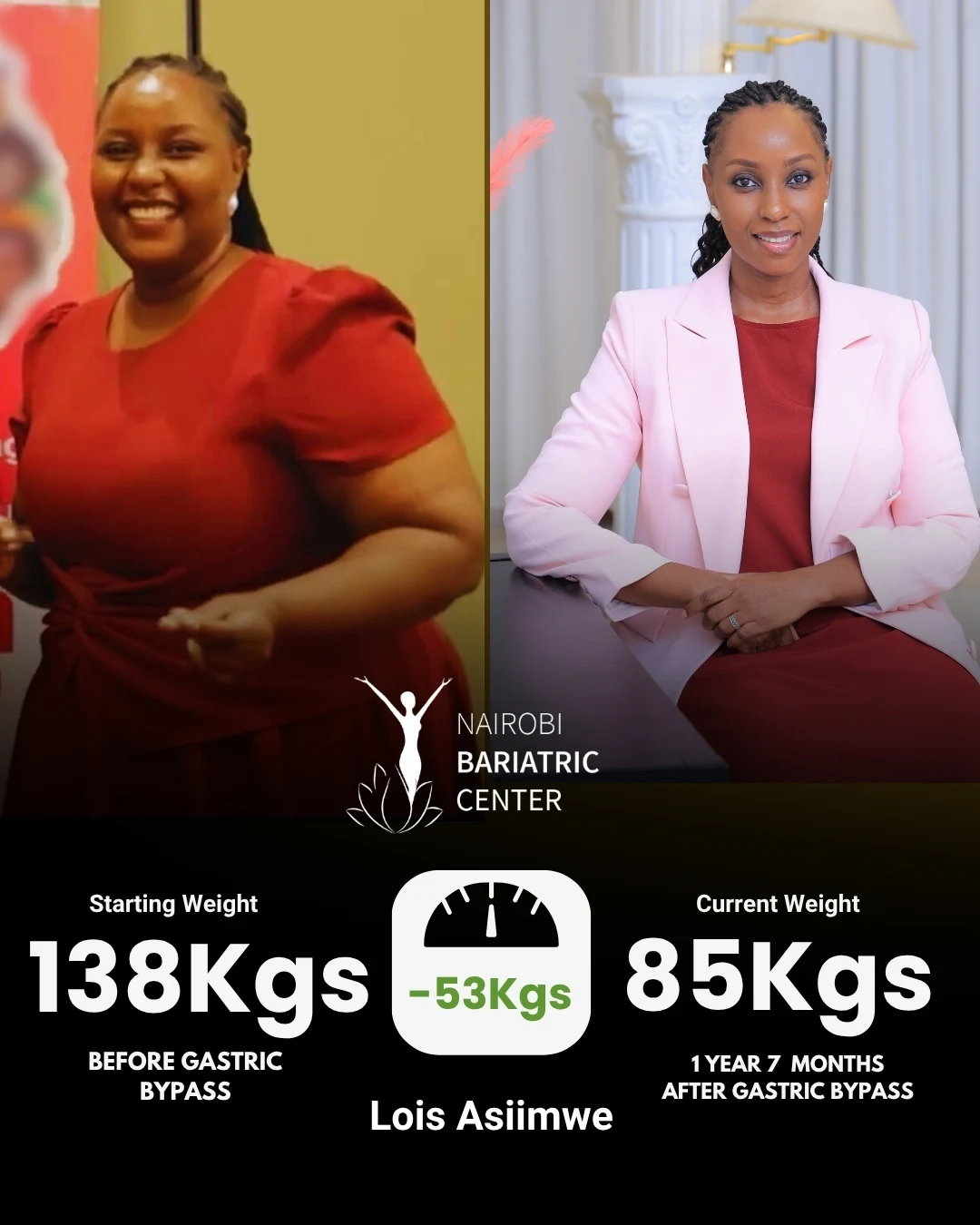 Lois Asiimwe — Gastric Bypass