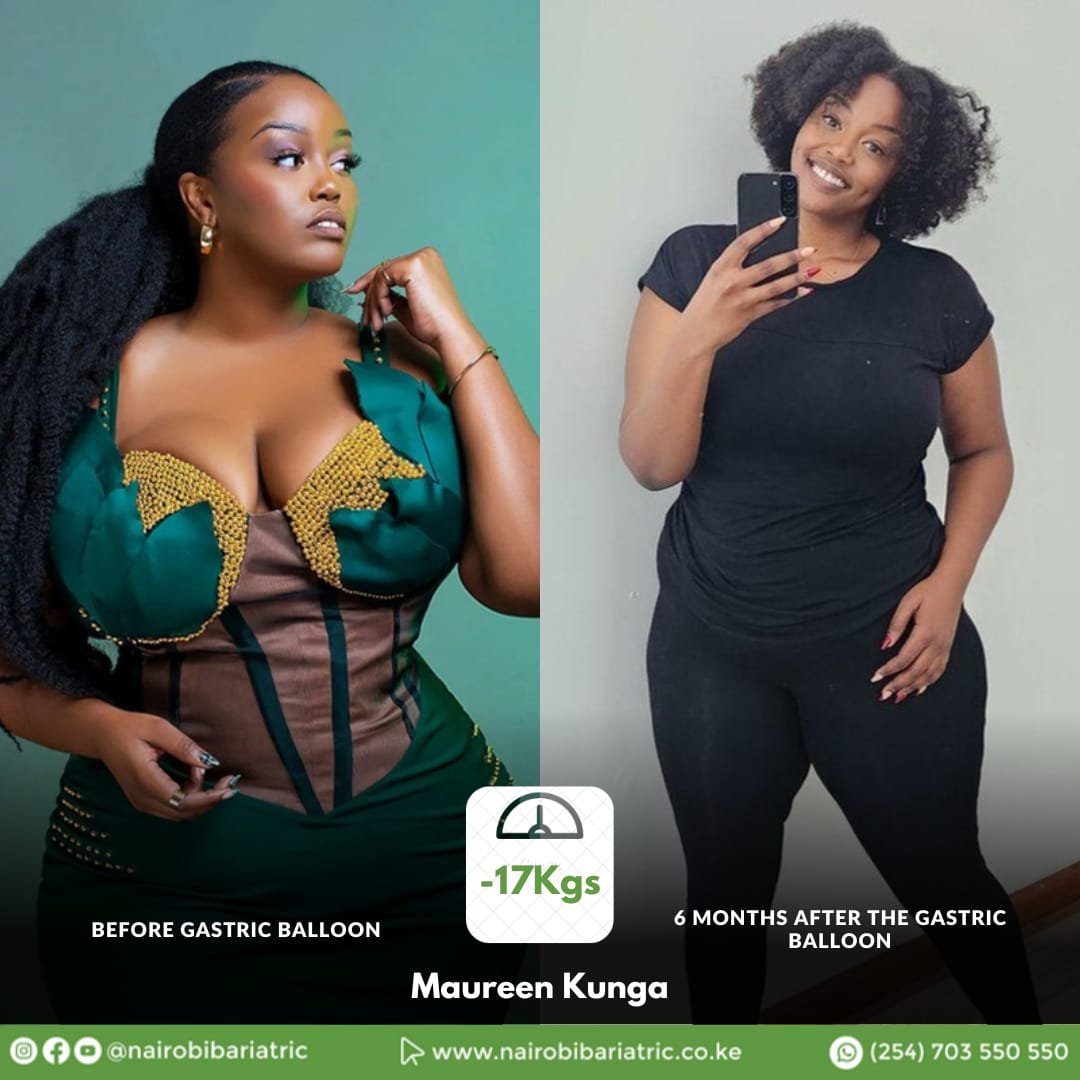 Maureen Kunga — Gastric Balloon
