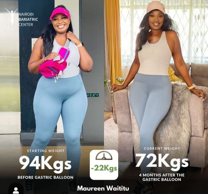 Maureen Waititu — Gastric Balloon