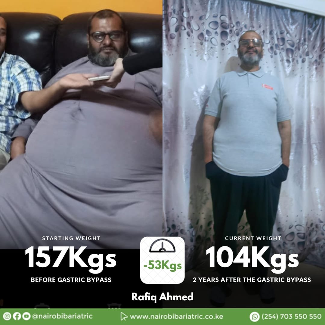 Rafiq Ahmed — Gastric Bypass