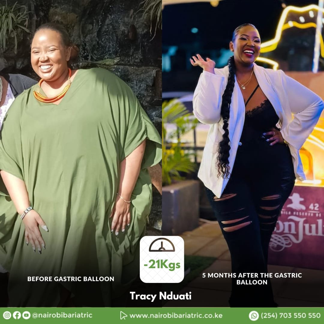 Tracy Nduati — Gastric Balloon